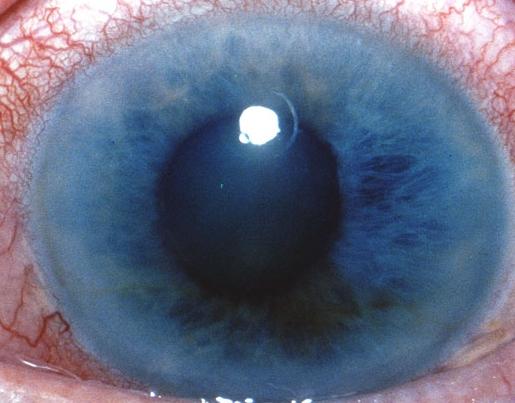 príznaky glaukómu oka